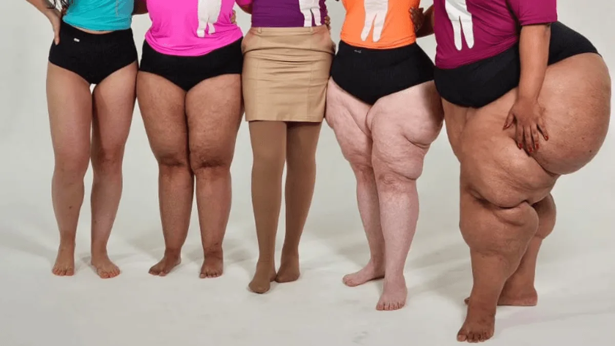 Lipedema — diferentes graus e apresentações da condição